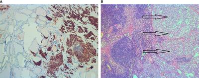 Case Report: <mark class="highlighted">Medullary Thyroid Cancer</mark> Workup Initiated by Unexpectedly High Procalcitonin Level—Endocrine Training Saves Life in the COVID-19 Unit